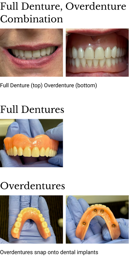 A close-up photo showcasing two types of dental prosthetics: a full denture, featuring a complete set of artificial teeth, and an overdenture, supported by dental implants for added stability, both displayed on a professional dental model.